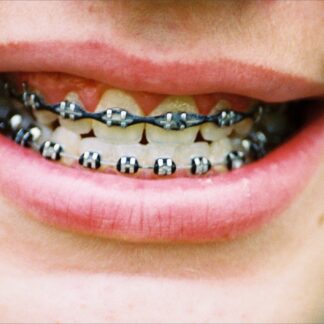 Braces and oral care
