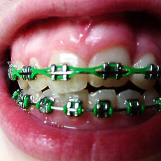 Vancouver orthodontist-braces care