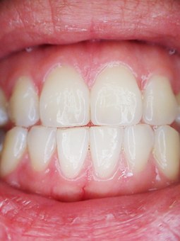 Adult Braces: Are You Considering Straighter Teeth?