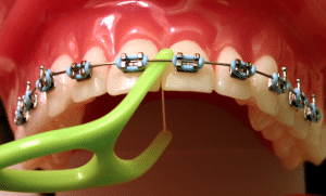 Flossing with Braces